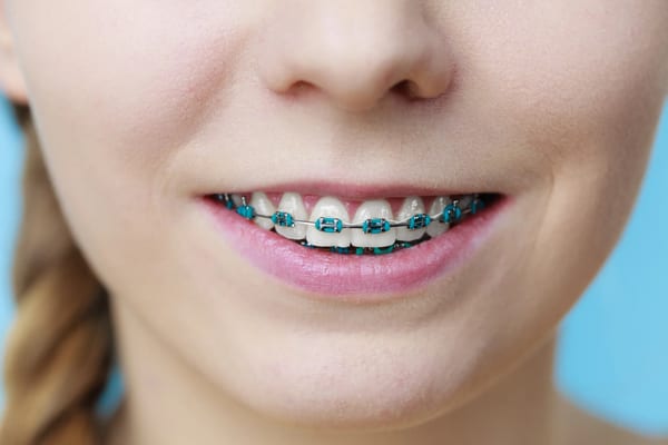 Traditional Braces